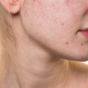 Acne Grau 1: Saiba Identificar O Estágio Menos Severo Da Doença