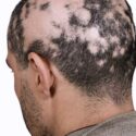 Alopecia: Entenda As Falhas No Cabelo