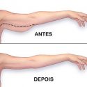 Gordura No Braço: Como Faço Para Perder?