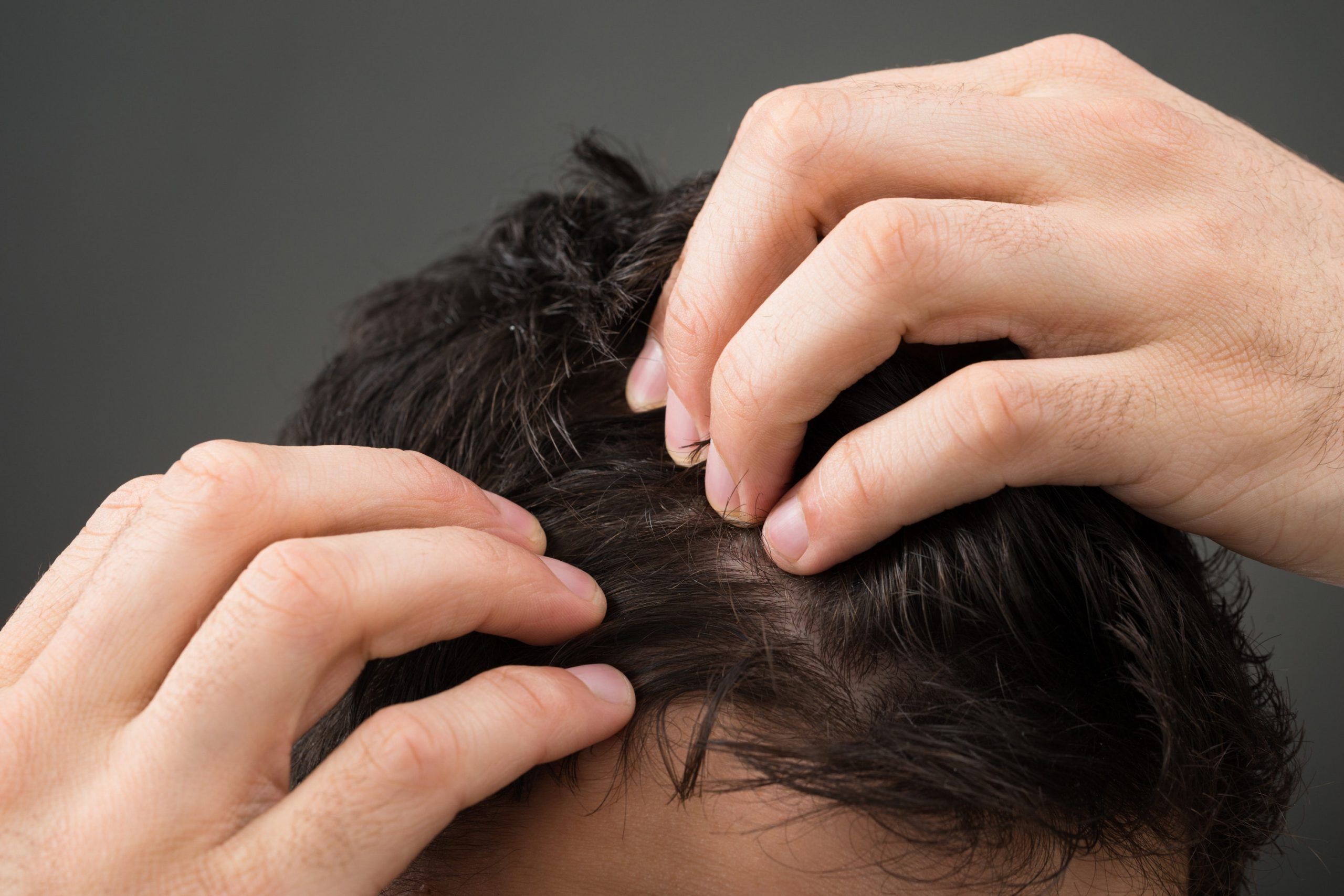 Confira tratamentos de queda de cabelo para homens