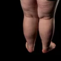Lipedema E Os Sinais Silenciosos: Saiba O Que é, Os Sintomas E Tratamentos
