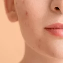 Acne Hormonal: O Que é, Causas E Como Tratar